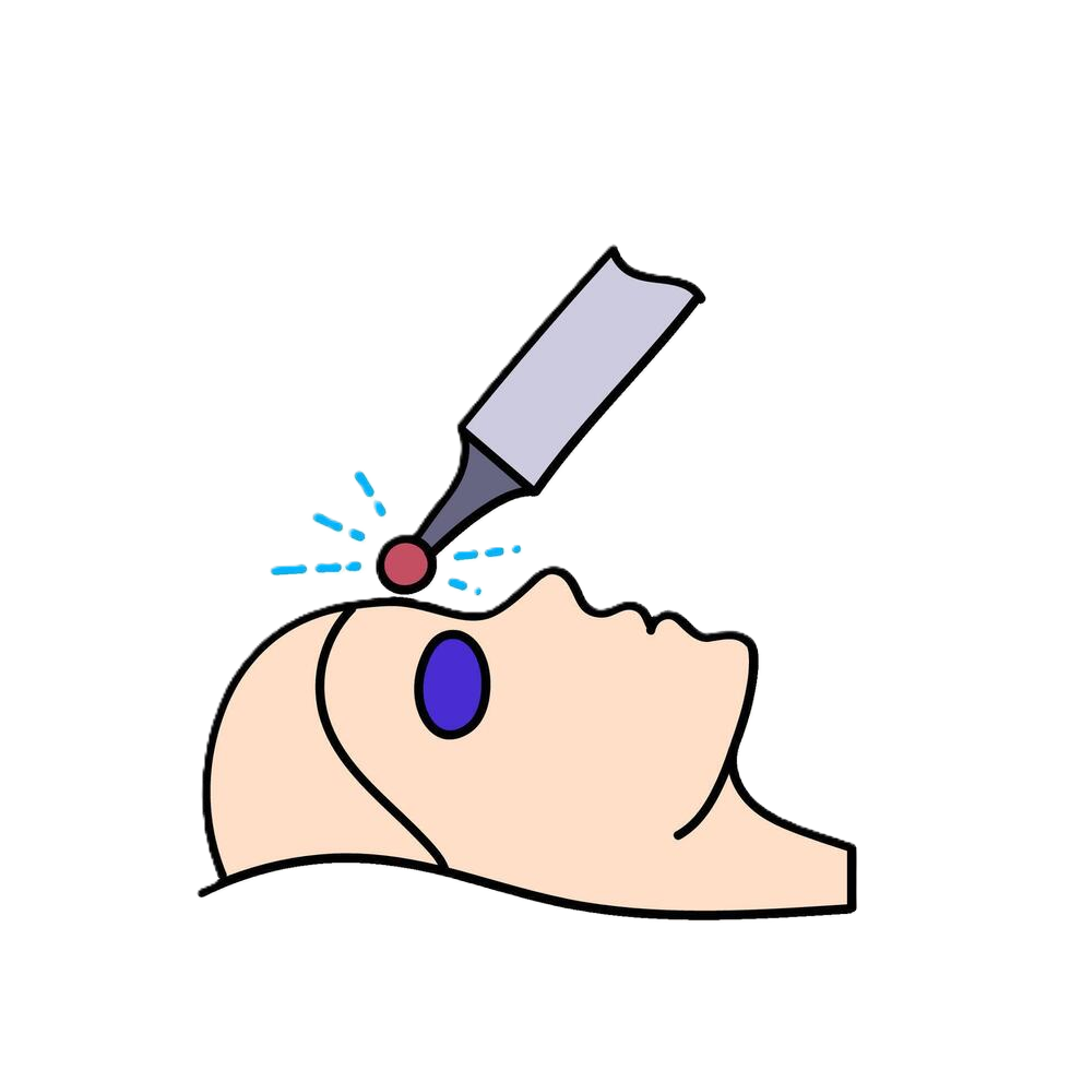 pico-laser-treatment